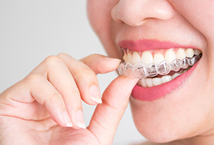 治療スタート（アライナー装着）