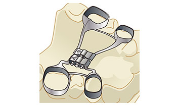 急速拡大装置(ラピッドエクスパンジョン)