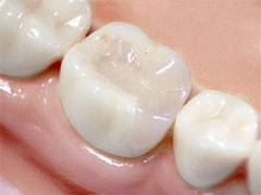 フルジルジルコニア