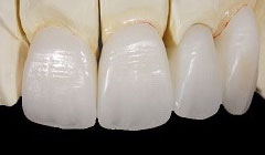 審美性、機能性、耐久性など、全ての面で優れたセラミック