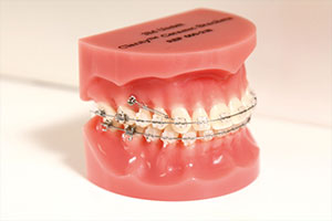 ワイヤー矯正の問題点を解決するアンカースクリュー矯正