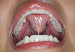 バイトホップ(噛む力と舌を持ち上げる力を強くする)