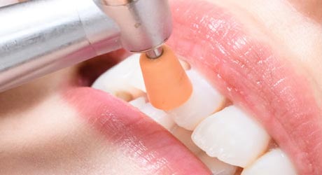 PMTC(プロフェッショナル・メカニカル・トゥース・クリーニング)