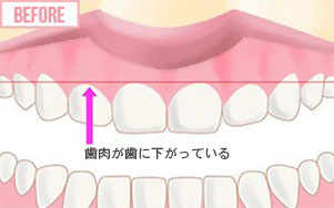 歯肉整形のイメージ