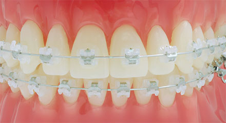 目立ちにくい白い矯正装置を使用