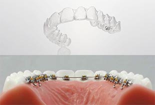 ハーフリンガル部分矯正