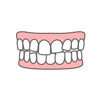 叢生・乱杭歯・八重歯