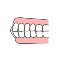 上下顎前突・口ゴボ