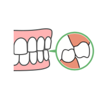 鋏状咬合・シザースバイト