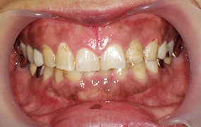 歯ぐきのガムピーリング