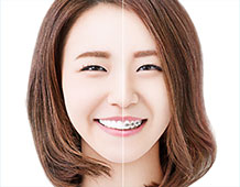 ハーフリンガル矯正