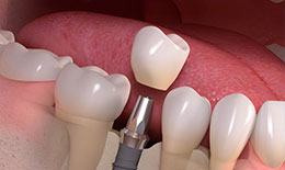 被せ物を含んだ分かりやすい料金形態