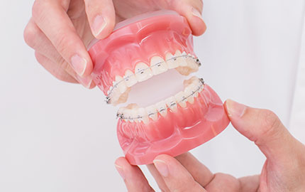 表側矯正とは？