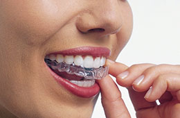 最後インビザライン治療にて再度修正