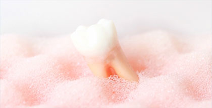 抜歯するケースが少ない