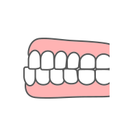 受け口・反対咬合